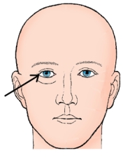 <strong>The external landmark identified in the figure below is the: </strong> A) glabella. B) acanthion. C) outer canthus. D) infraorbital margin.