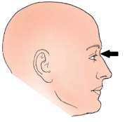 <strong>The landmark identified in the figure below is termed the: </strong> A) nasion. B) glabella. C) acanthion. D) inner canthus.