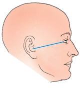 <strong>The topographic line shown in the figure below is the: </strong> A) glabellomeatal. B) orbitomeatal. C) acanthiomeatal. D) infraorbitomeatal.