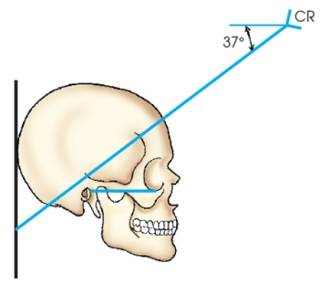 <strong>Which method of examining the skull is identified in the figure below? </strong> A) Haas B) Towne C) Shüller D) Caldwell