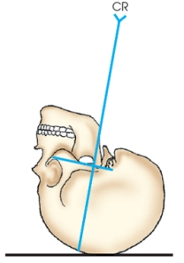 <strong>The x-ray projection demonstrated in the figure below is the: </strong> A) SMV. B) VSM. C) AP axial. D) PA axial.
