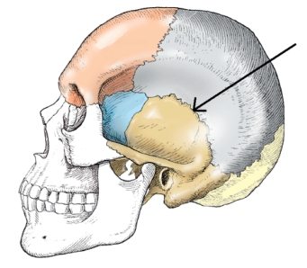 <strong>The suture identified on the figure below is the: </strong> A) coronal. B) squamosal. C) sagittal. D) lambdoidal.