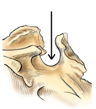 <strong>The part of the sphenoid bone identified in the figure below is the: </strong> A) clivus. B) foramen magnum. C) sella turcica. D) dorsum sellae.