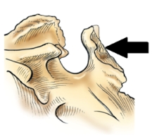 <strong>The part of the sphenoid bone identified in the figure below is the: </strong> A) clivus. B) clinoid processes. C) sella turcica. D) dorsum sellae.