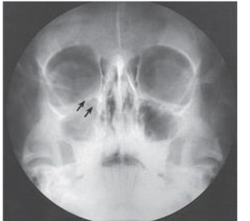 <strong>What is the projection (method)demonstrated in the image below used to evaluate trauma to the orbit? </strong> A) Parietoacanthial (Waters) B) PA axial (Caldwell) C) AP axial (Towne) D) PA axial (Haas)