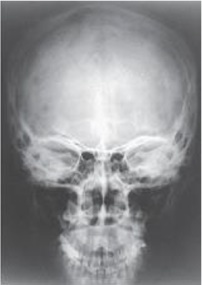 What projection (method)used to evaluate the cranium is demonstrated in the image below?