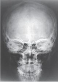 How was the central ray directed to obtain the image below,used to evaluate the cranium?