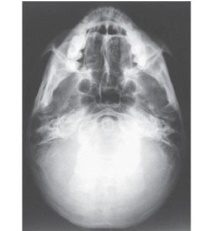 How was the central ray directed to obtain the image below,used to evaluate the cranium?