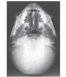 What projection (method)is demonstrated in the image below,used to evaluate the cranium?