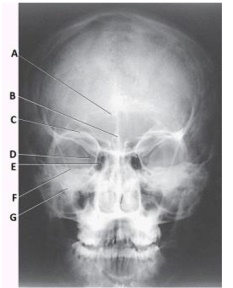 What projection (method)is demonstrated in the image below,used to evaluate the cranium?