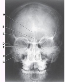 What structure is labeled as letter B in the image below,used to evaluate the cranium?