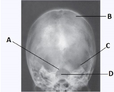 What projection (method)is demonstrated in the image below,used to evaluate the cranium?