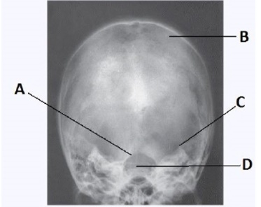 Letter A in the image below,used to evaluate the cranium,labels the: