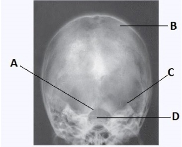 Letter B in the image below,used to evaluate the cranium,labels the: