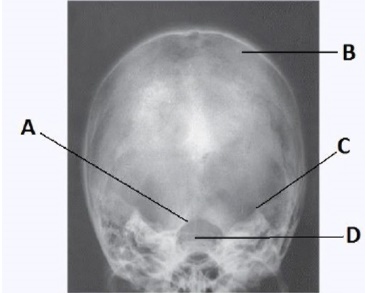 Letter D in the image below,used to evaluate the cranium,labels the: