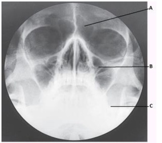 What projection (method)is demonstrated in the image below of the paranasal sinuses?