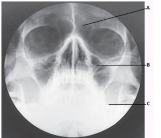 Which paranasal sinuses are labeled with the letter A in this image?