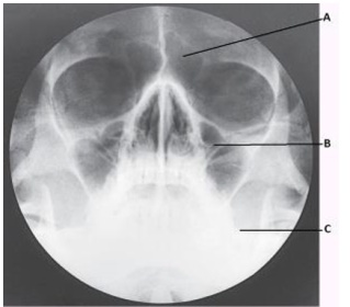 The letter C in the image below of the paranasal sinuses labels the: