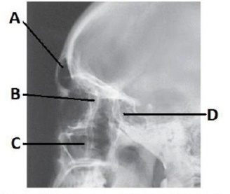 The letter C in the image below of the paranasal sinuses labels the: