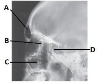 The letter D in the image below of the paranasal sinuses labels the _____ sinuses.