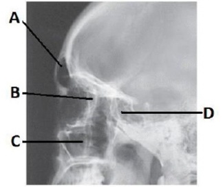 The letter B in the image below of the paranasal sinuses labels the _____ sinuses.