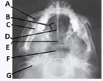The letter D in the image below of the paranasal sinuses labels the: