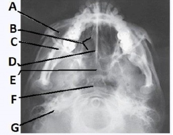 The letter E in the image below of the paranasal sinuses labels the _____ sinuses.
