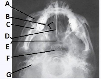 The letter F in the image below of the paranasal sinuses labels the: