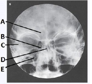 The letter A in the image below of the paranasal sinuses labels the _____ sinuses.