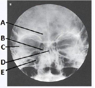 The letter B in the image below of the paranasal sinuses labels the _____ sinuses.
