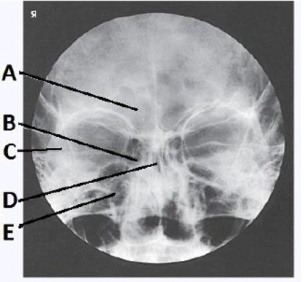 The letter C in the image below of the paranasal sinuses labels the: