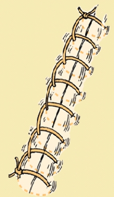 <strong>The nurse is preparing to remove a patient's sutures.What technique demonstrates correct technique? </strong> A) Snip first suture distal to knot, then snip second suture on the same side. B) Snip suture distal to knot and pull through skin in one smooth motion. C) Place end of suture extractor under suture and pull upwards. D) Pull the exposed suture through the skin and out through the other side.