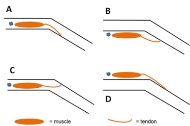 The figure below represents a joint in the hind leg of a grasshopper.The exoskeleton of the leg is indicated by the two pairs of parallel black lines.A muscle that moves this leg is fixed to the skeleton at the end marked with a blue star.When the muscle contracts, it will pull on the tendon at its opposite end.Which configuration shows the most likely arrangement of the exoskeleton and a muscle that increases the flexion of this leg?