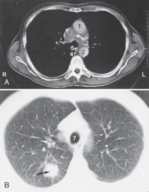 <strong>The structure labeled as 2 is the: </strong> A) ascending aorta. B) descending aorta. C) esophagus. D) superior vena cava.