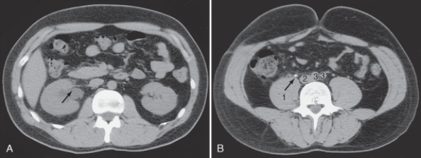 <strong>The psoas muscle is labeled: </strong> A)1. B)2 C)3. D)4.
