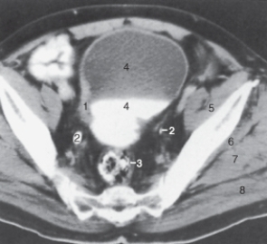 <strong>The structure labeled as 2 is the: </strong> A) renal calculus. B) iliac artery. C) ureter. D) iliac vein.