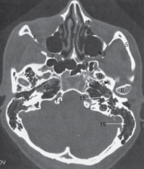 <strong>The structure labeled 5 is the:  </strong> A) lateral orbital wall. B) mandibular condyle. C) temporal bone. D) zygomatic arch. <div style=padding-top: 35px> 