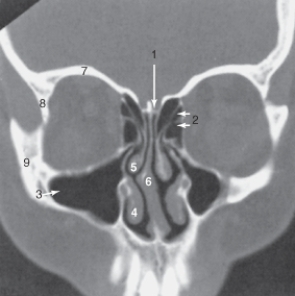 <strong>The structure labeled 7 is the:  </strong> A) cribriform plate. B) lateral orbital wall. C) roof of the orbit. D) zygoma. <div style=padding-top: 35px> 