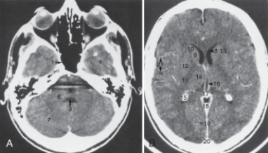 <strong>The structure labeled 15 is the:  </strong> A) calcified choroid plexus. B) fourth ventricle. C) pons. D) third ventricle. <div style=padding-top: 35px> 