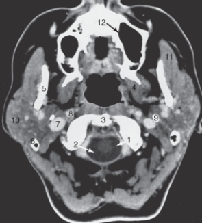 <strong>The structure labeled as 1 is the:  </strong> A) internal carotid artery. B) masseter muscle. C) odontoid process. D) spinal cord. <div style=padding-top: 35px> 