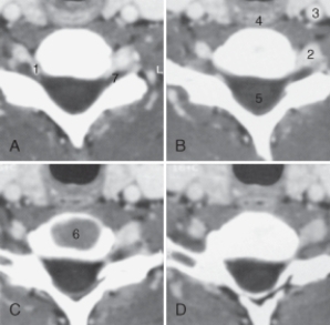 <strong>The intervertebral disk is labeled:  </strong> A)4 B)5. C)6. D)7. <div style=padding-top: 35px> 