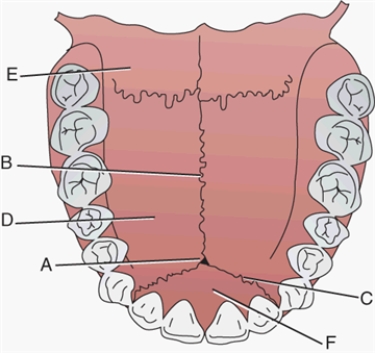 Match each labeled landmark or bone in the following figure to the correct descriptor.   -Palatine process