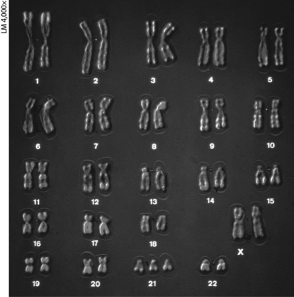 <strong> The karyotype above shows ________.</strong> A)abnormal sex chromosomes B)trisomy 21, a cause of Klinefelter syndrome C)Turner syndrome D)trisomy 21, a cause of Down syndrome