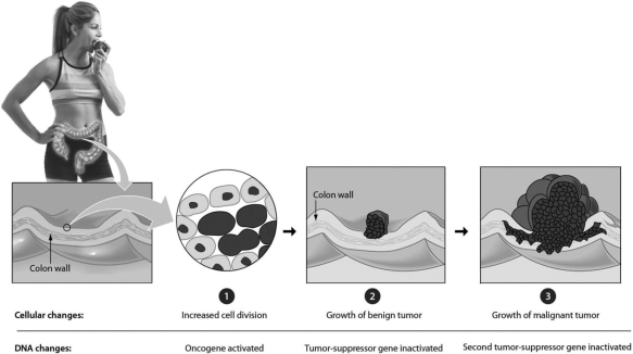 <strong>In a typical colon cancer, the first step is ________. </strong> A)the inactivation of a tumor-suppressor gene B)the mutation of a tumor-suppressor gene, producing an oncogene C)the mutation of a proto-oncogene, producing an oncogene D)the conversion of an oncogene to a tumor-suppressor gene