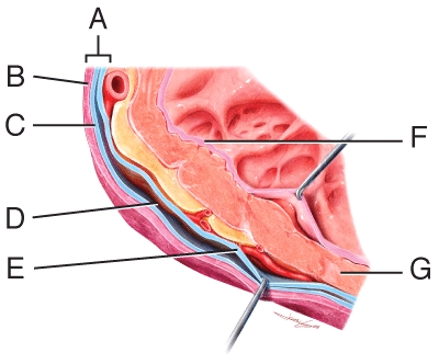 <strong>Which labeled structure in the heart wall diagram is responsible for the pumping action of the heart?  </strong> A)A B)B C)E D)F E)G <div style=padding-top: 35px> 