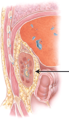 <strong>What structure is the arrow is pointing to? </strong> A) suprarenal gland B) adipose capsule C) quadratus lumborum D) peritoneum