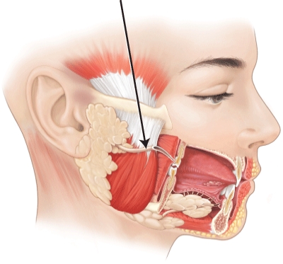 <strong>What structure is the arrow is pointing to?  </strong> A) parotid duct B) mylohyoid duct C) submandibular duct D) sublingual duct <div style=padding-top: 35px> 