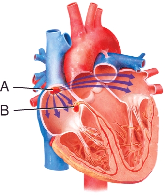 <strong>Match the component of the conduction system of the heart with the description. Sinoatrial (SA) node:  </strong> A) sends wave of depolarization throughout atria B) located in the interatrial septum <div style=padding-top: 35px> 