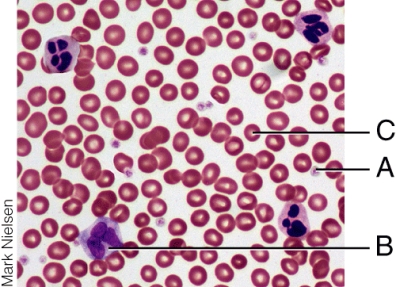 <strong>Which cell type is involved in the condition known as Leukemia?  </strong> A) A B) B C) C D) All of the choices are correct. <div style=padding-top: 35px> 