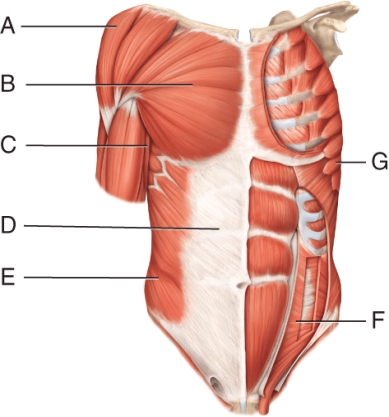<strong>The muscle indicated by line G  </strong> A) depresses the scapula B) abducts the sapula C) inserts on the lateral border D) is innervated by the dorsal scapular nerve E) is the swimmer's muscle <div style=padding-top: 35px> 